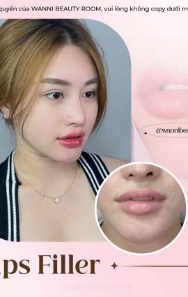 TIÊM FILLER UY TÍN TẠI GÒ VẤP