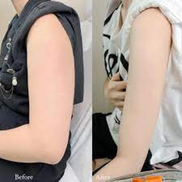 GỌN CƠ BẮP TAY