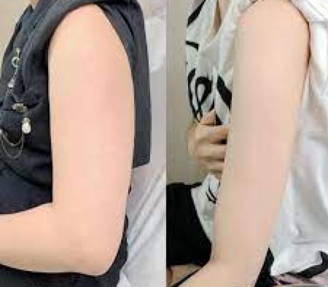 GỌN CƠ BẮP TAY