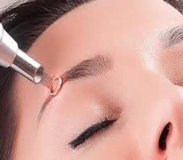 XÓA MÀY LASER 1 LẦN